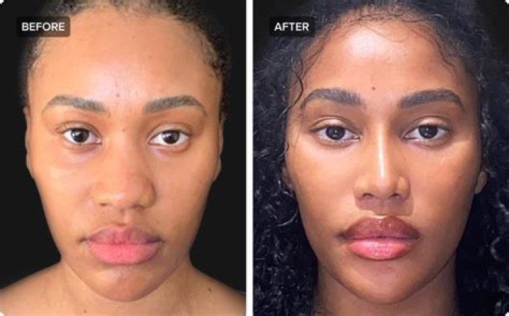 Did Hailee Steinfeld Undergo Nose Job? Plastic Surgery Rumors Addressed