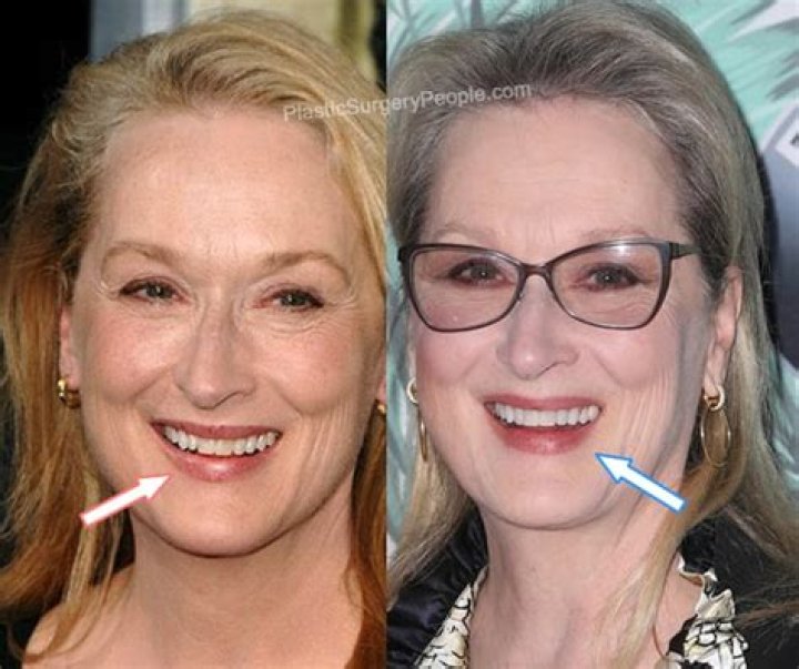 Meryl Streep Plastic Surgery Photos, Does She Have A Fake Teeth?